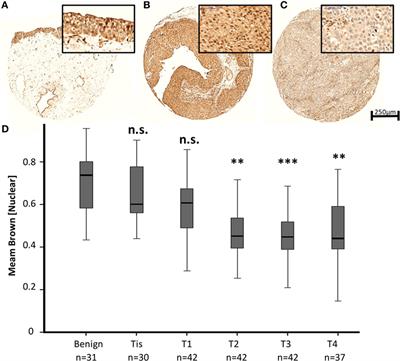 Mediator Complex Subunit MED1 Protein Expression Is Decreased during Bladder Cancer Progression